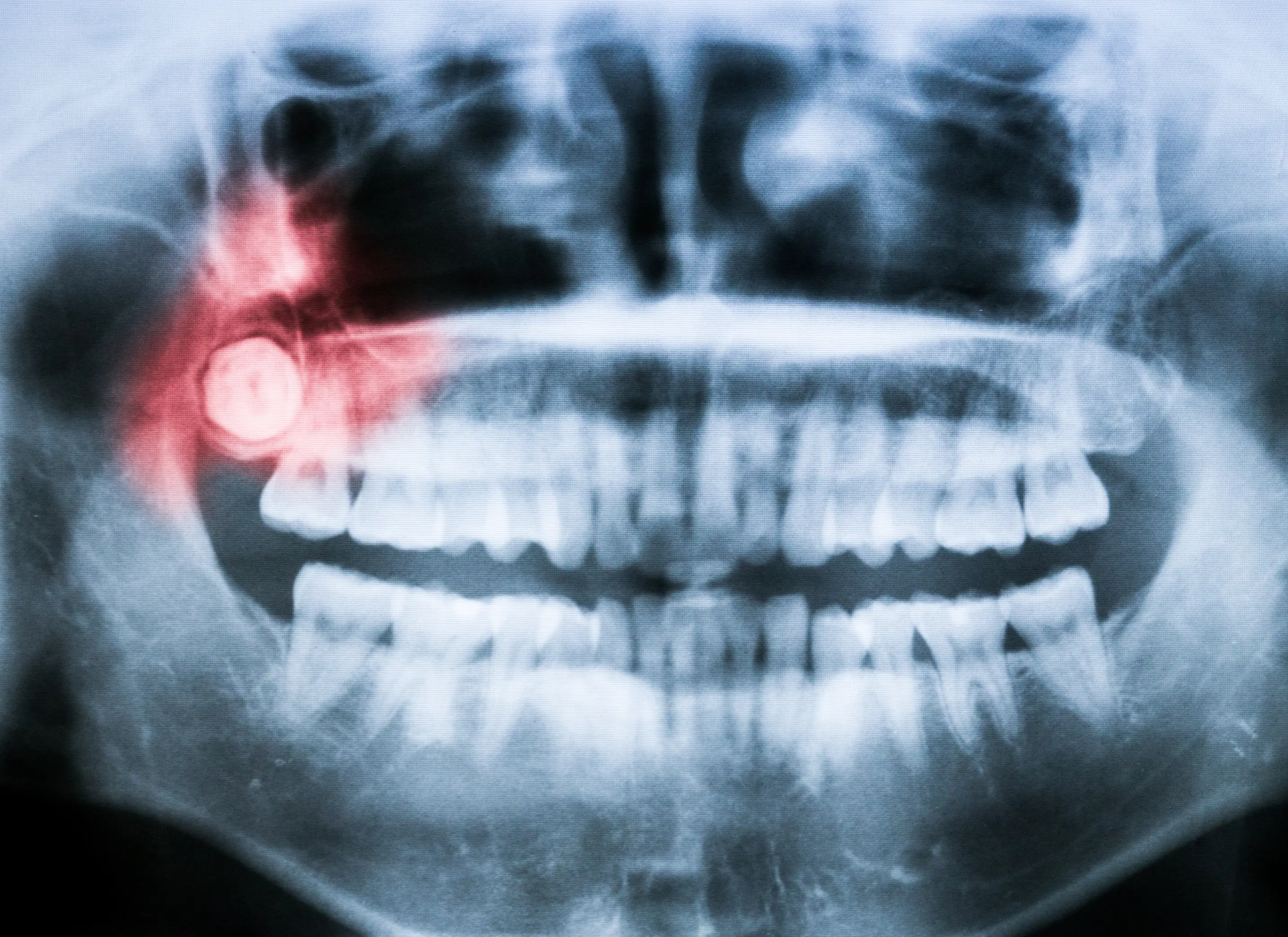 Wisdom Teeth Evaluations: What to Expect & Why Early Action Matters